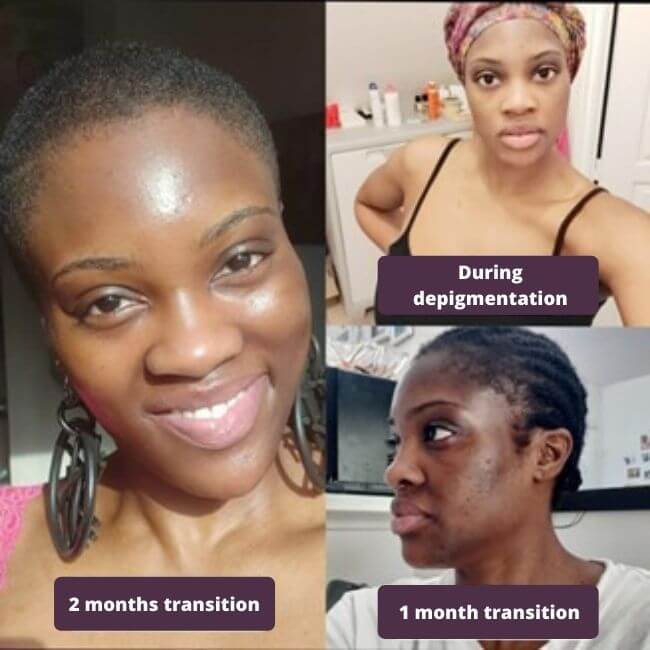 Stop Lightening Post Depigmentation Care IN OYA